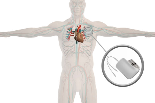 Pacemaker Placement | GlobeHealer