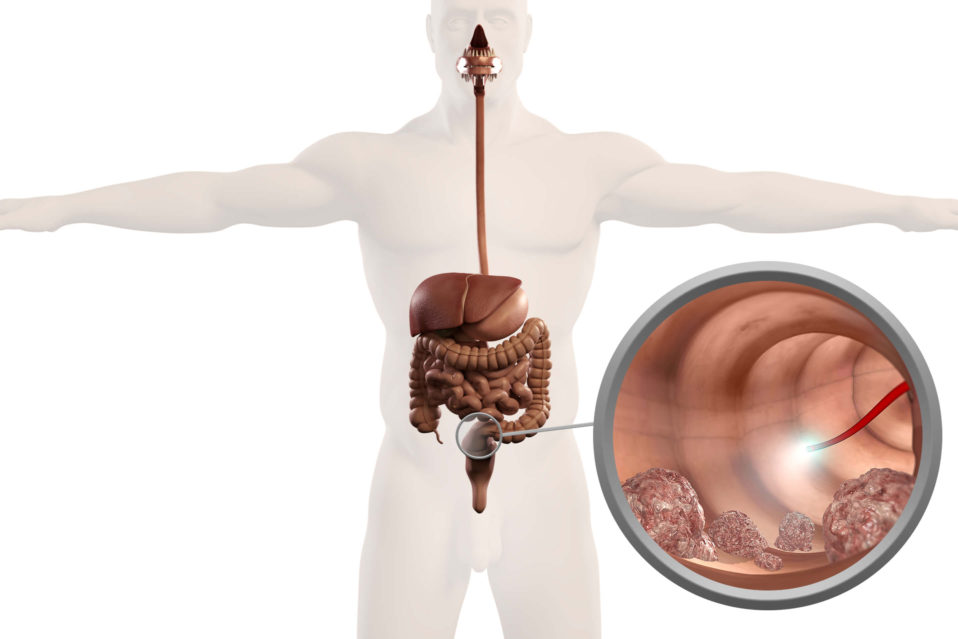 What Causes Restricted Mobility Of The Colon During A Colonoscopy