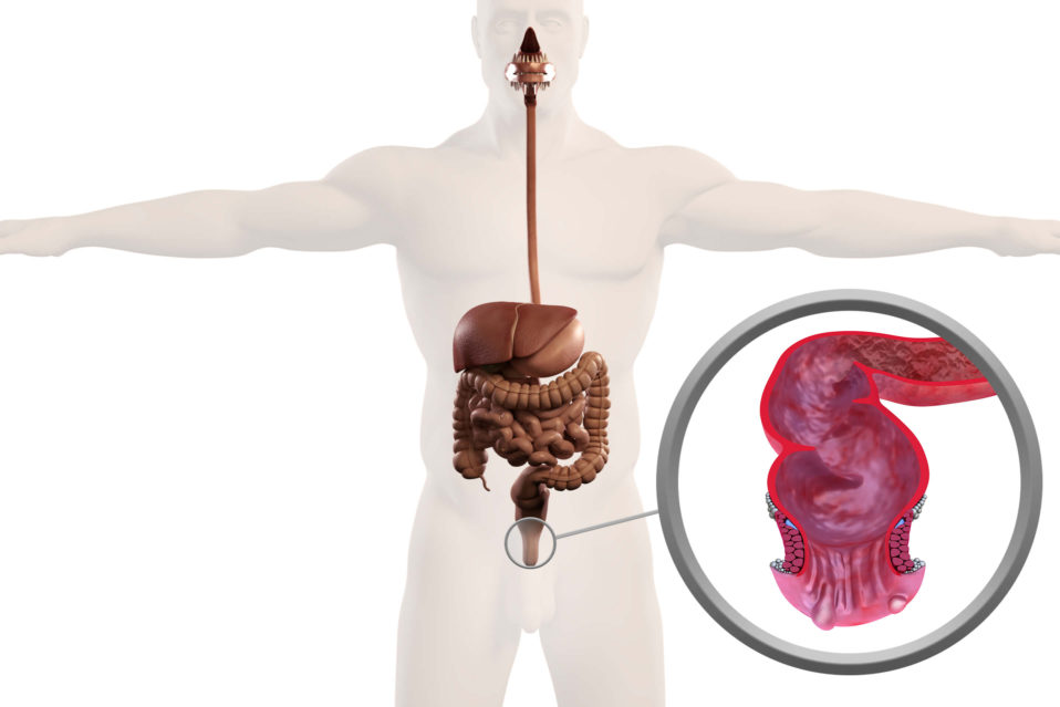 How Much Time Off Work After Hemorrhoid Surgery