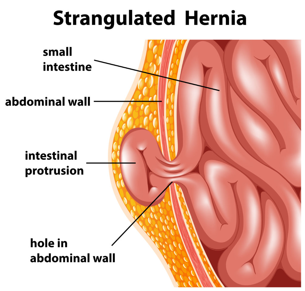 Abdominal Wall Hernia Repair GlobeHealer