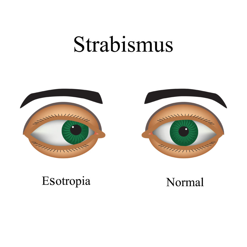 treatment-of-strabismus-globehealer